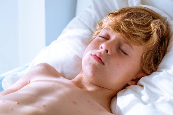 Windpocken-Fälle sind rückläufig